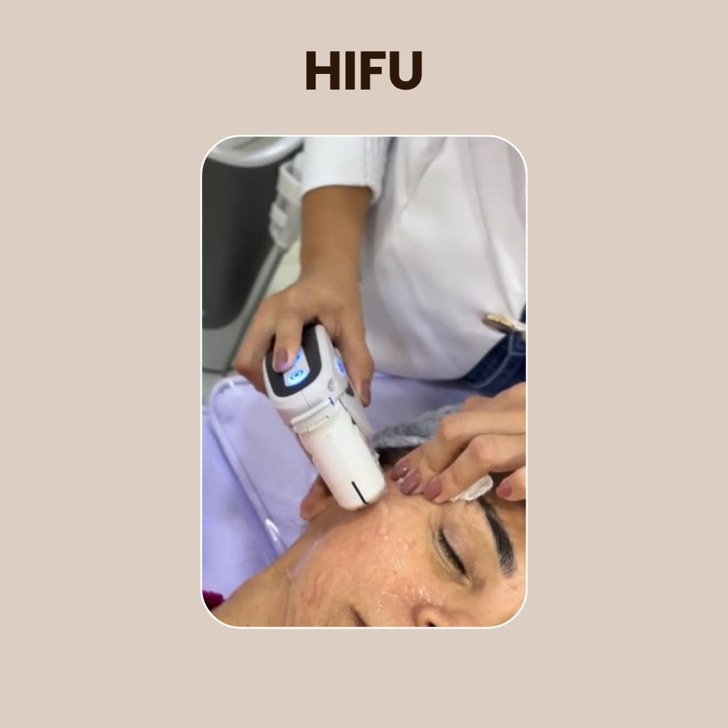 Ultramed HIFU — procedimento de lifting facial na VIDEN